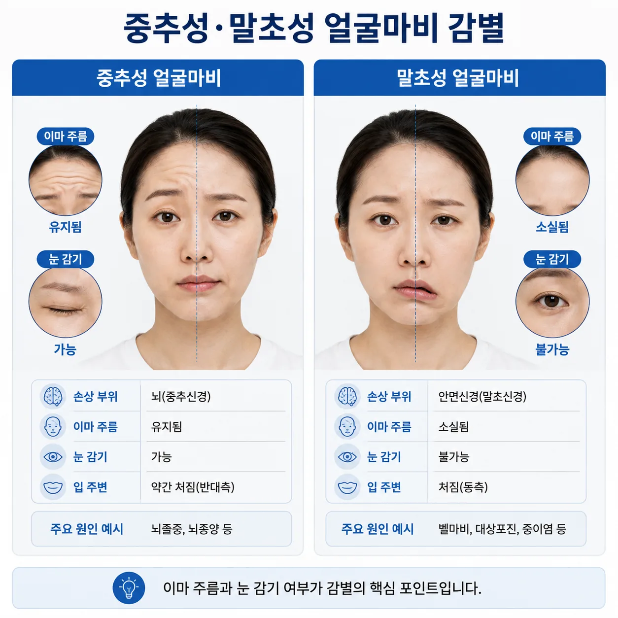 중추성 얼굴마비와 말초성 얼굴마비 감별 도해