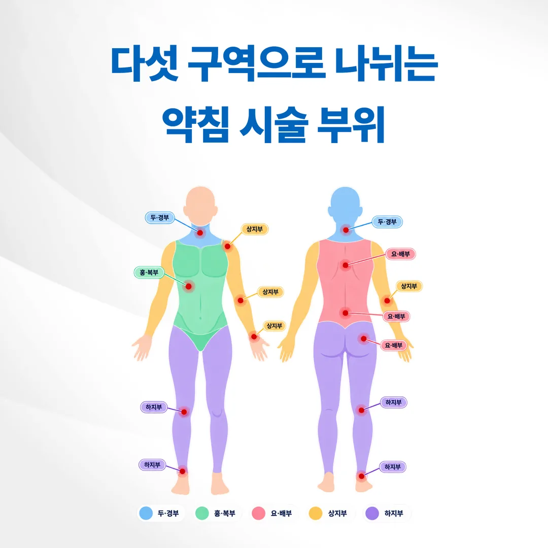 약침 시술 부위를 두경부 흉복부 요배부 상지부 하지부 다섯 구역으로 나눈 인체 도해