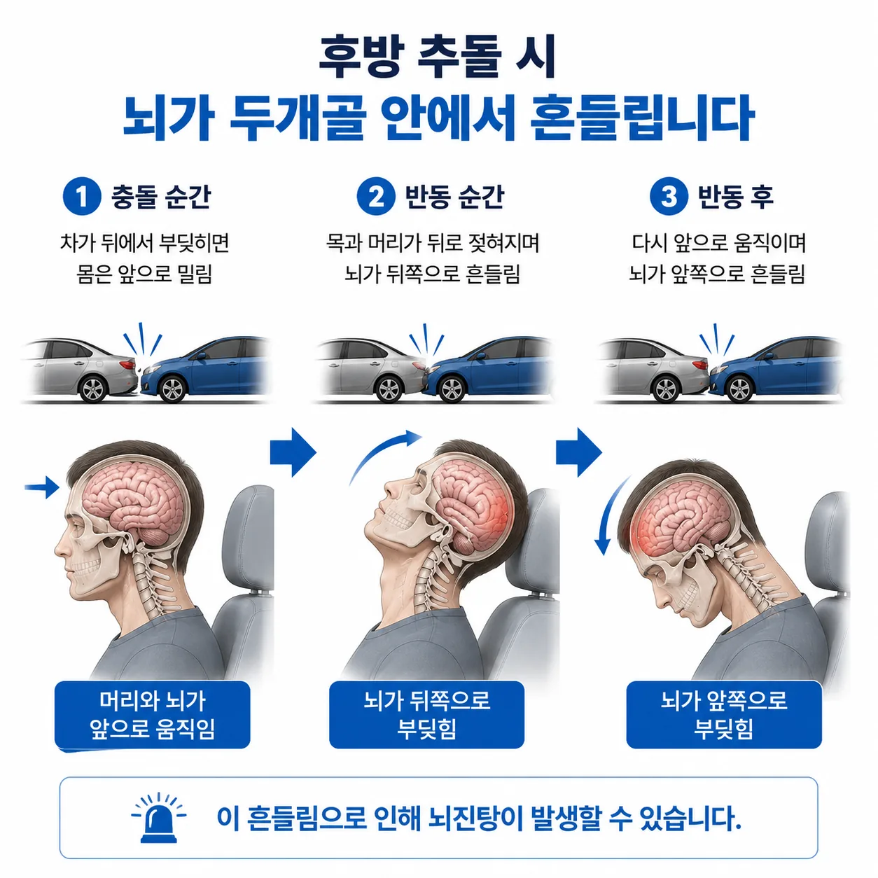 교통사고 가속 감속에 의한 뇌진탕 발생 기전 도해