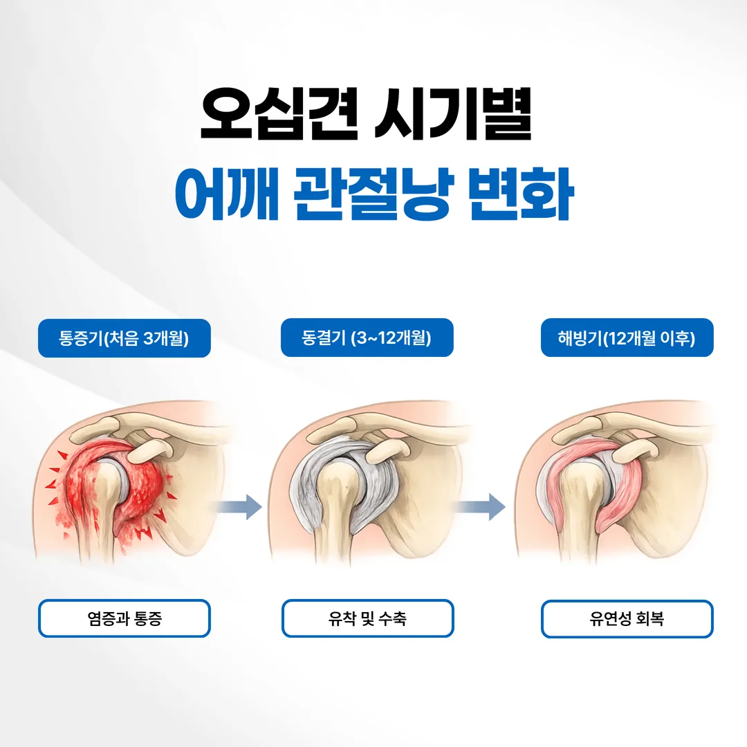 오십견 시기별 어깨 관절낭 변화 도해