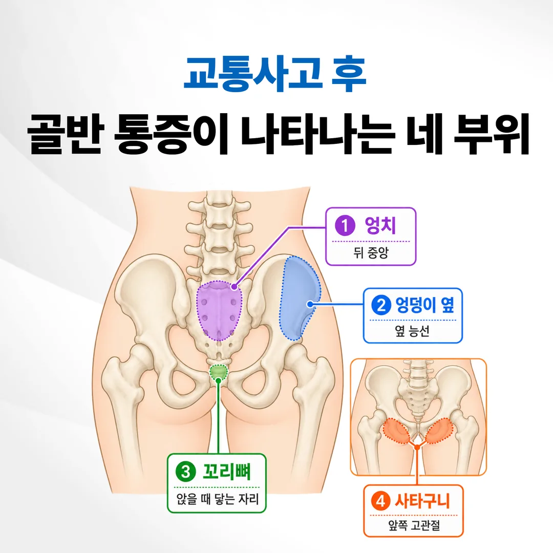 교통사고 후 골반 통증이 나타나는 네 부위를 표시한 도해