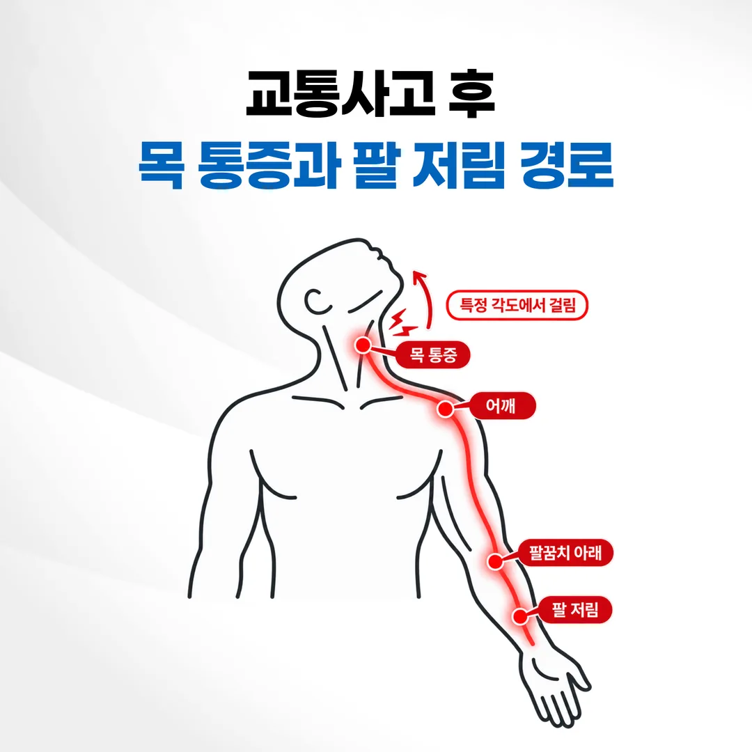 교통사고 후 목 통증과 팔 저림이 이어지는 경로 개념도