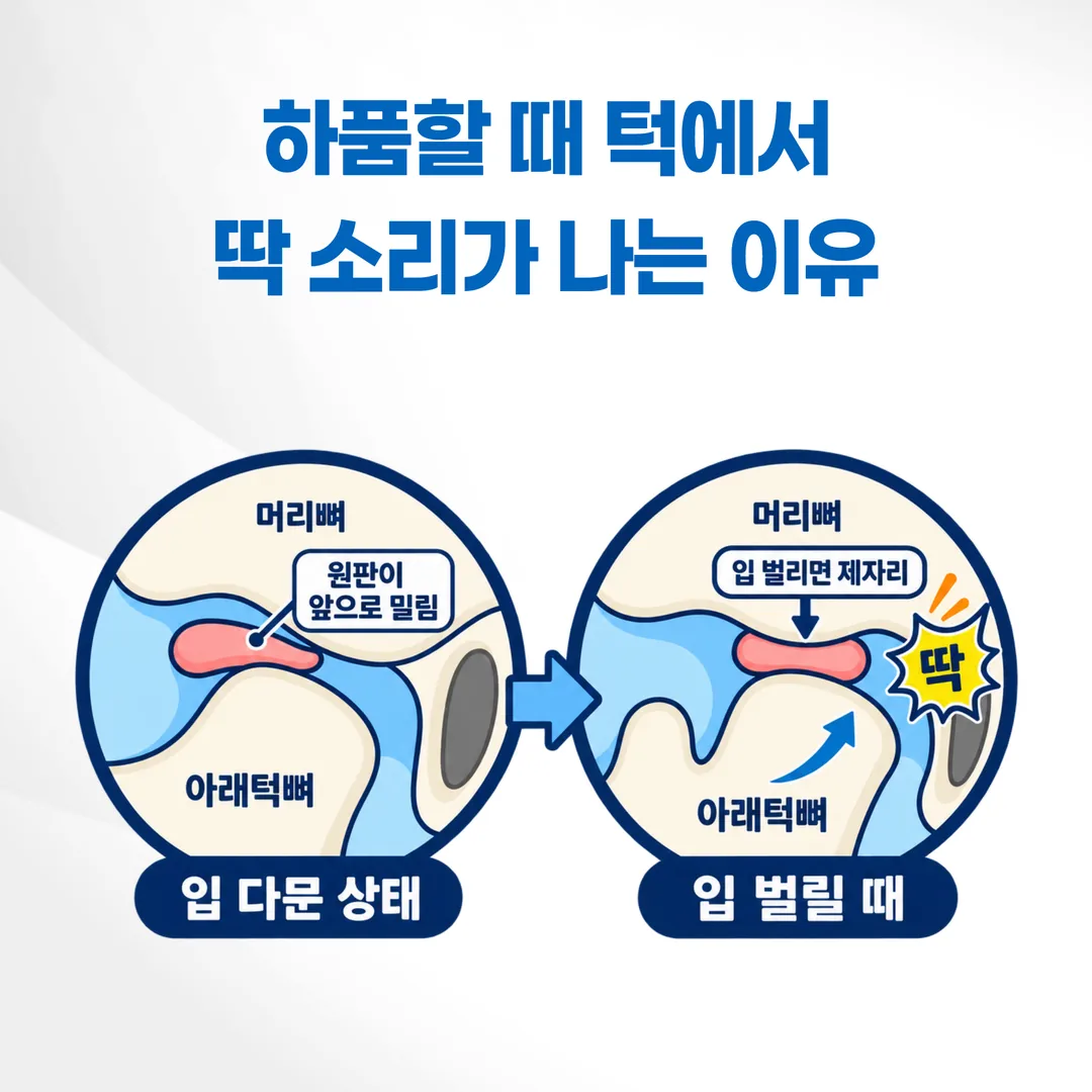 턱관절과 관절원판의 위치, 입을 벌릴 때 디스크가 움직이는 과정을 보여 주는 그림