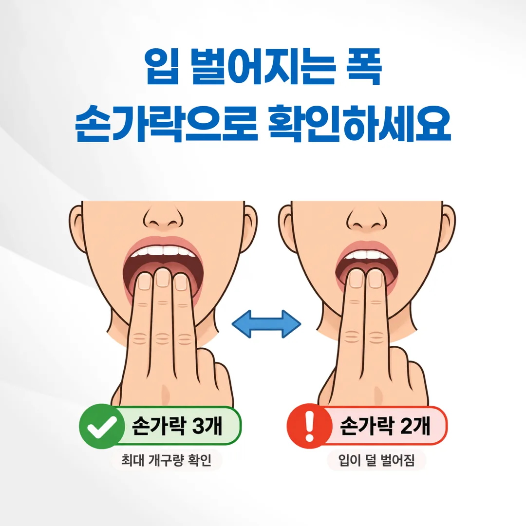 손가락 세 개를 세워 최대 개구량을 확인하는 방법을 보여 주는 도해