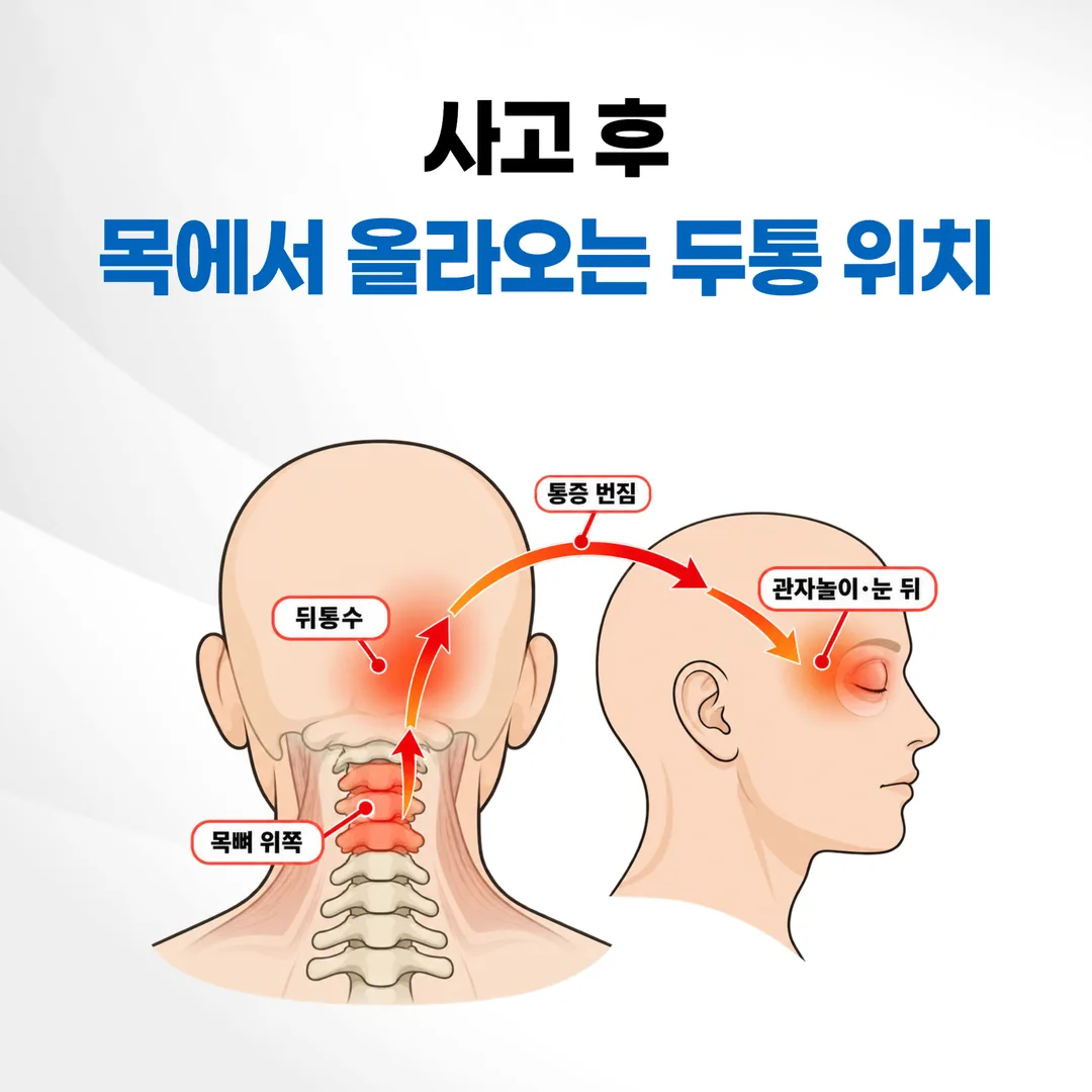 목뼈 위쪽에서 뒤통수와 관자놀이로 통증이 번지는 경추성 두통 위치 도식
